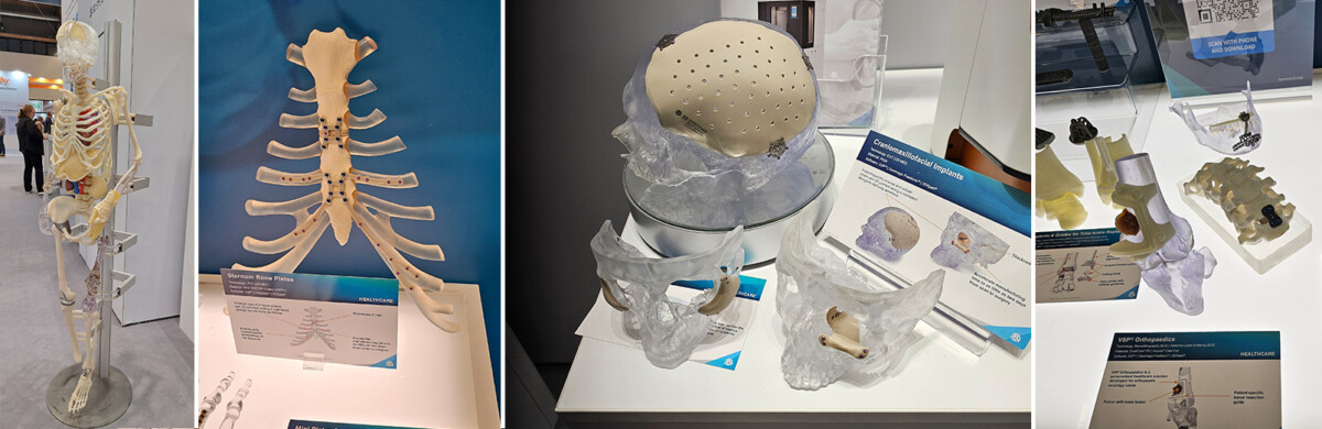 Kuvassa 3D-tulostettuja implantteja.