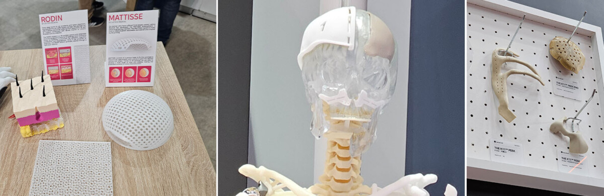 Kollaasissa on 3D-tulostettuja lääketieteellisiä implantteja: kallo- ja luuimplantteja, läpinäkyvä anatominen pää, jossa on valkoinen kalloimplantti, ja erilaisia taululle kiinnitettyjä implantteja.